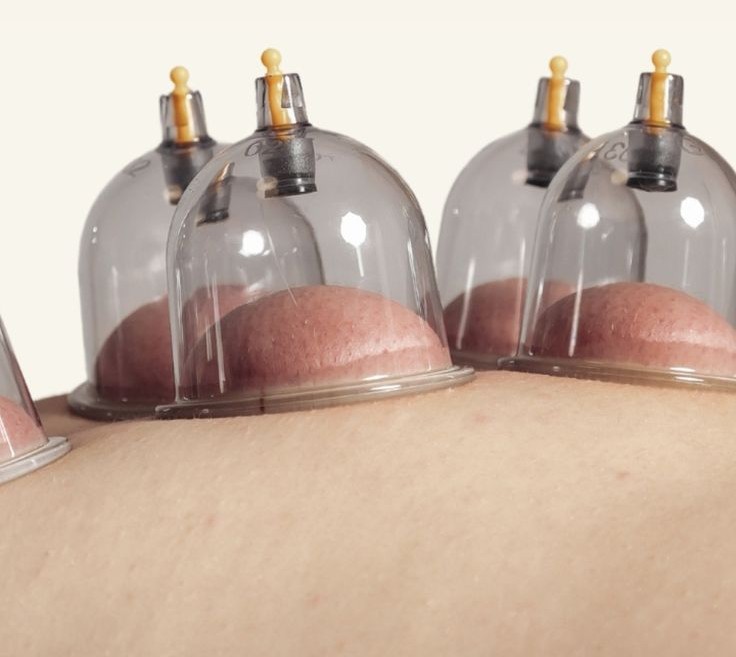 Cupping Therapy