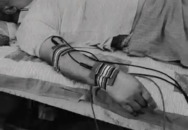 Paralysis